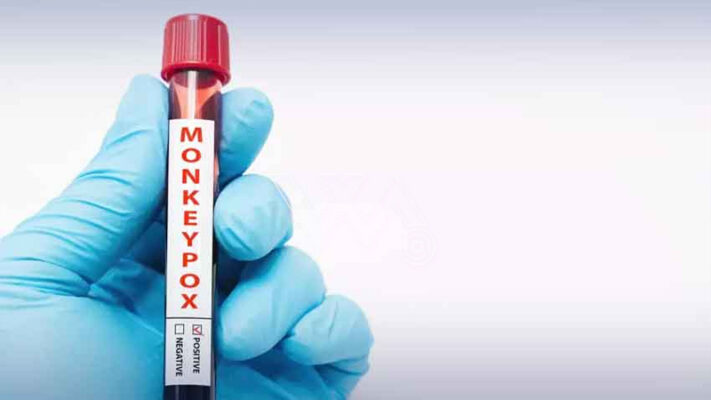 کراچی میں منکی پاکس کا ایک اور کیس رپورٹ